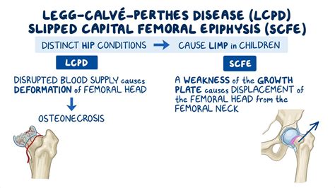 m2 perdos|Legg Calve Perthes Disease .